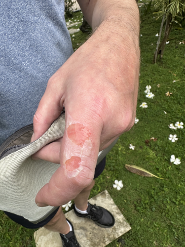 A little blistering goes a long way and sometimes things happen. This was a small set back during the scuba trip to Indonesia in 2025.#tridentwarriors